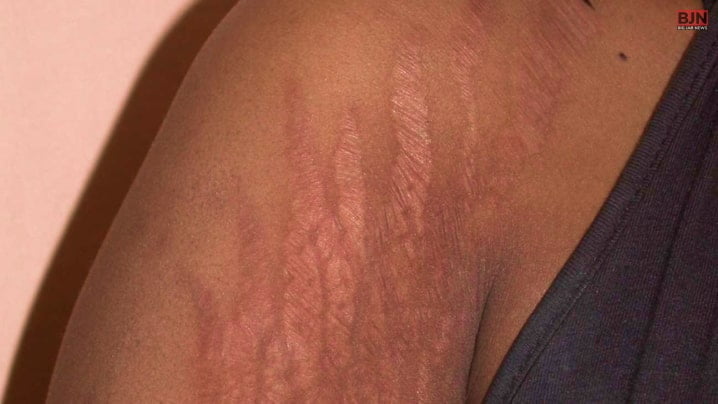 The Subtle Warning Signs_ Are Those Stretch Marks Trying to Tell You Something