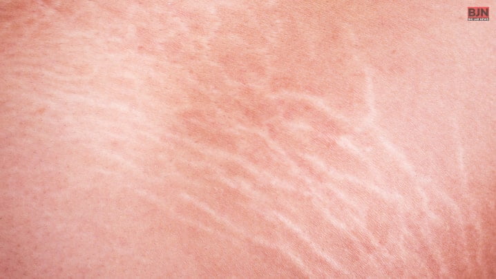 Understanding Cancerous Stretch Marks