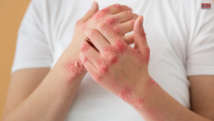 Irritant Contact Dermatitis