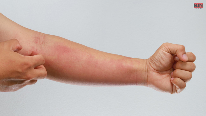 Physical Urticaria