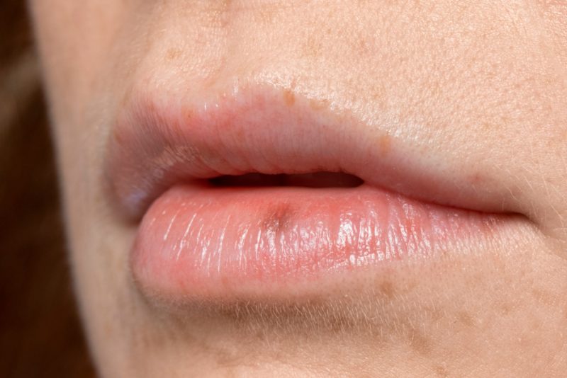 Lip Pigmentation