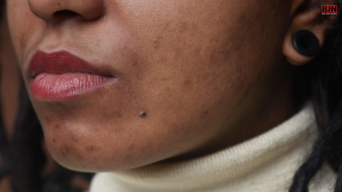 The Additional Key Causes Of Hyperpigmentation Around The Mouth_