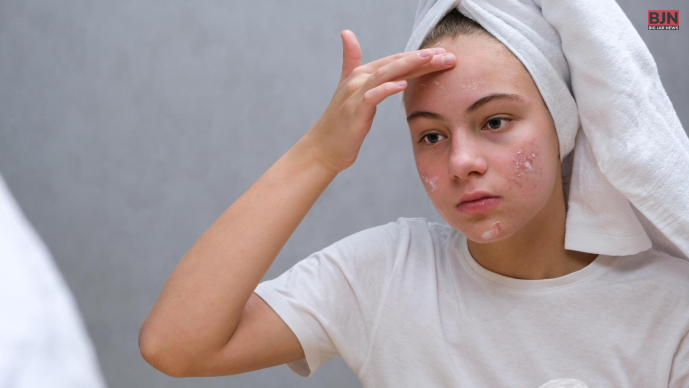 What Are The Best Ways To Prevent Acne Scars_