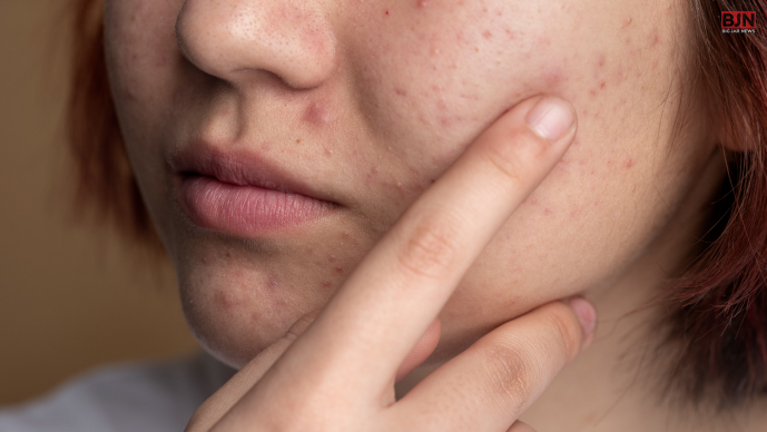 What Are The Types Of Acne_