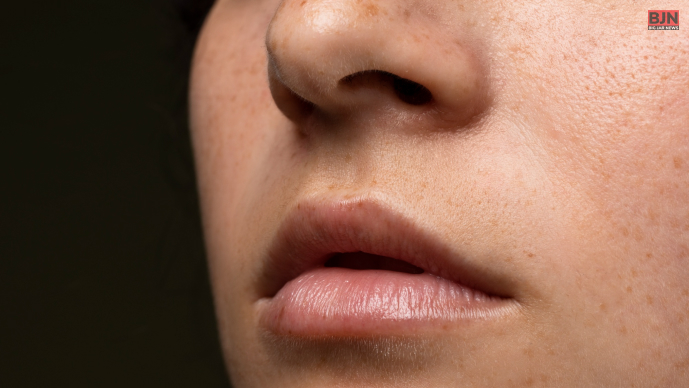 What Do You Mean By Hyperpigmentation Around The Mouth_