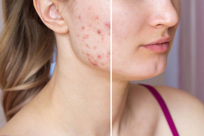 remove acne scars naturally in a week