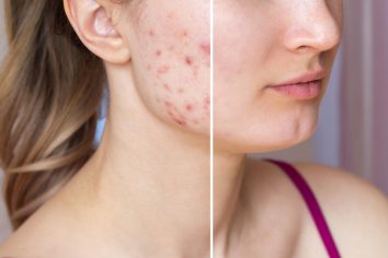 how to remove acne scars naturally in a week..