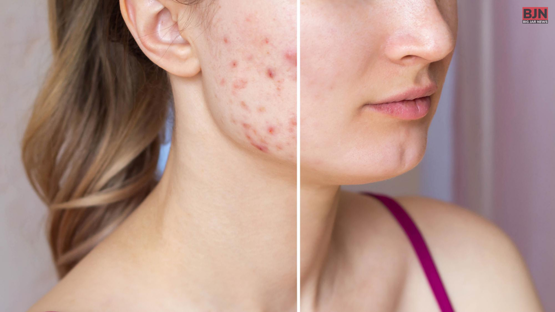 how to remove acne scars naturally in a week..